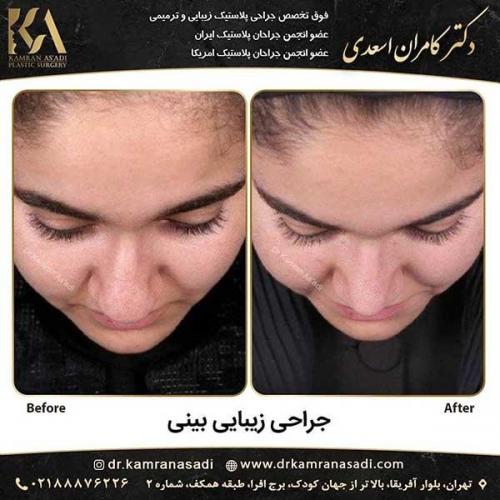 جراحی-بینی-دکتر-اسعدی-6-19
