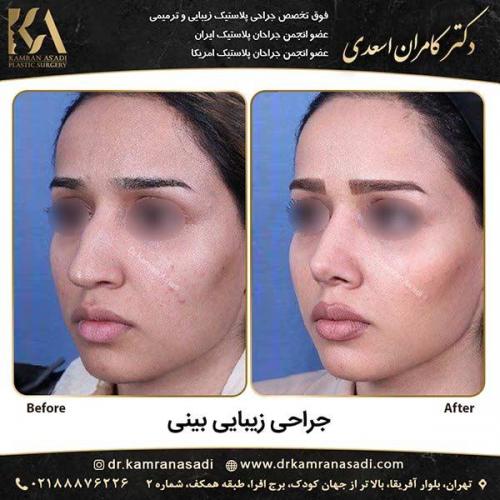 جراحی-بینی-دکتر-اسعدی-6-2