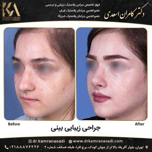 جراحی-بینی-دکتر-اسعدی-6-4