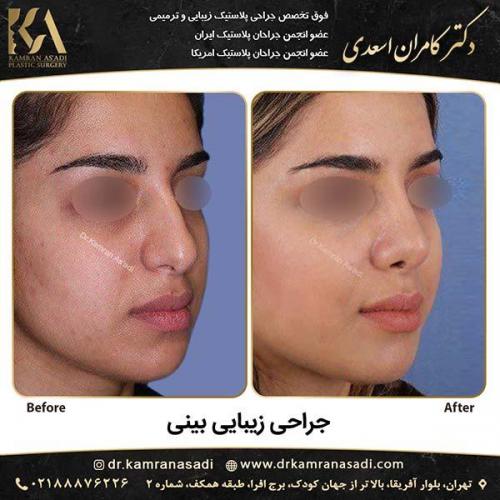 جراحی بینی دکتر اسعدی 1-1