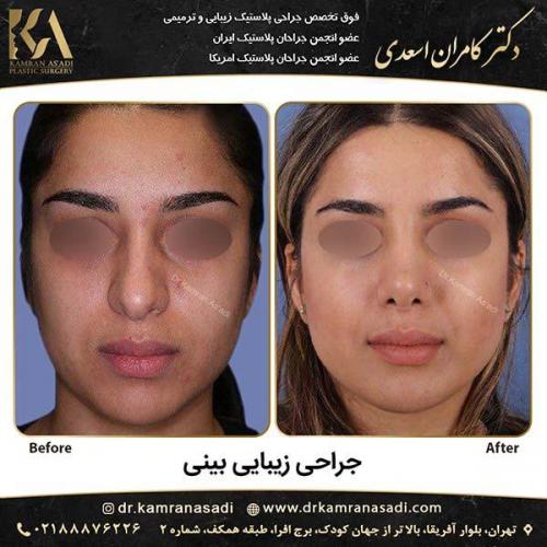جراحی بینی دکتر اسعدی 2-1.jpg